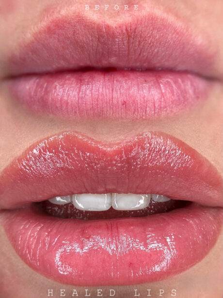 lips_vorher_nachher